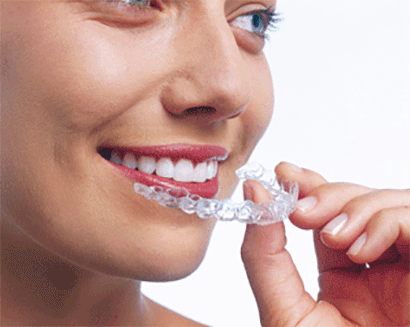 invisalign_anwendung