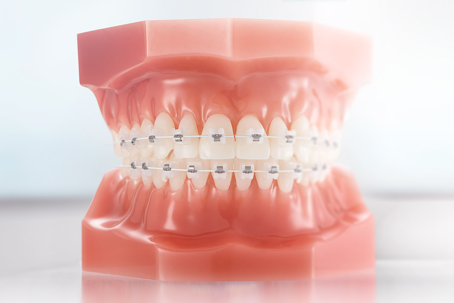 keramik_brackets_content3