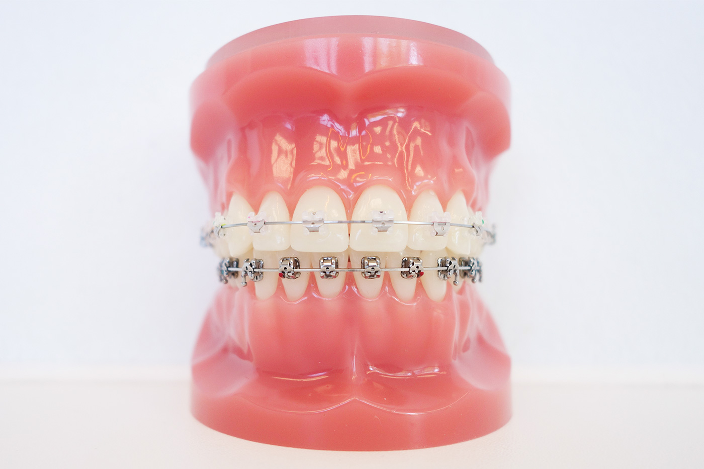 behandlungsdetails-jugendliche-zahnfarbene-keramikbrackets
